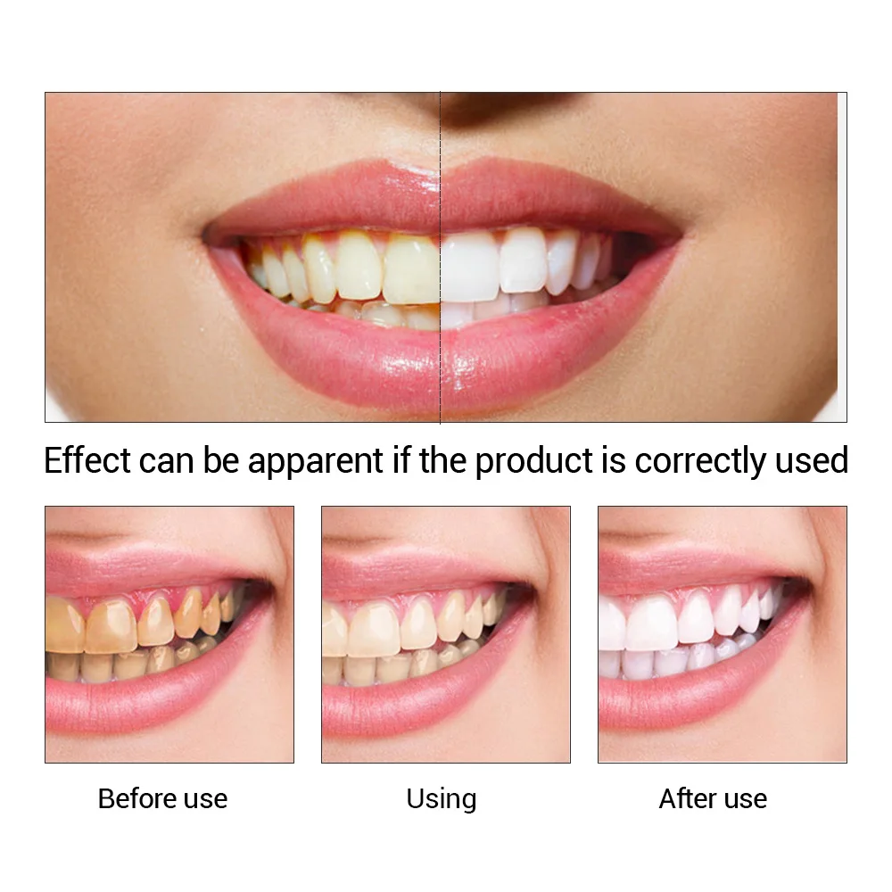 FTEENPLY Teeth Whitening Essen - Teeth Whitening Essence review and price