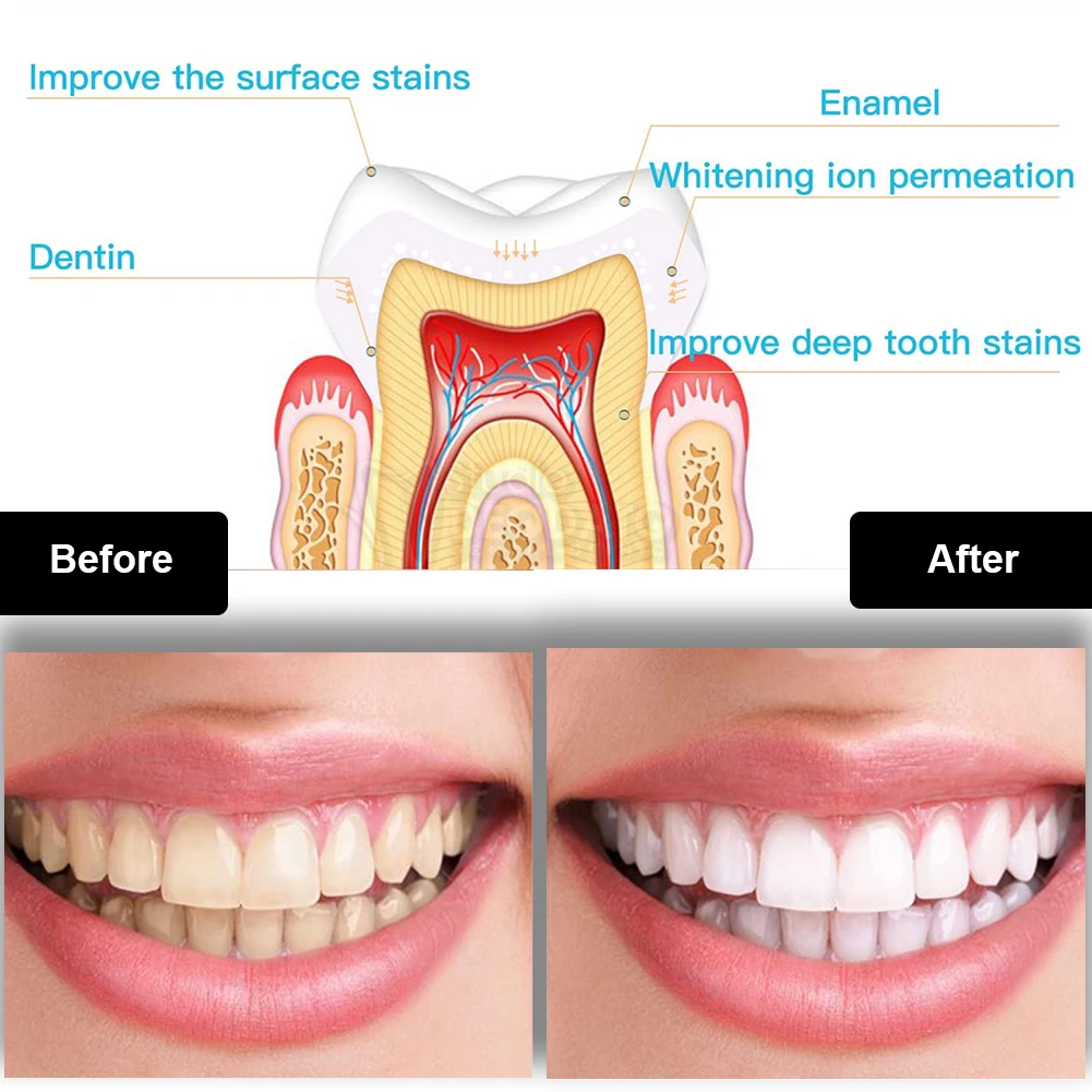 Dental Teeth Whitening Kit Min - Teeth Whitening Essence review and price